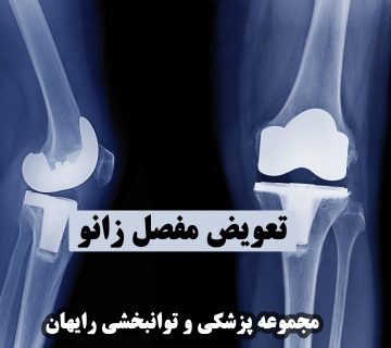 تعویض مفصل زانو