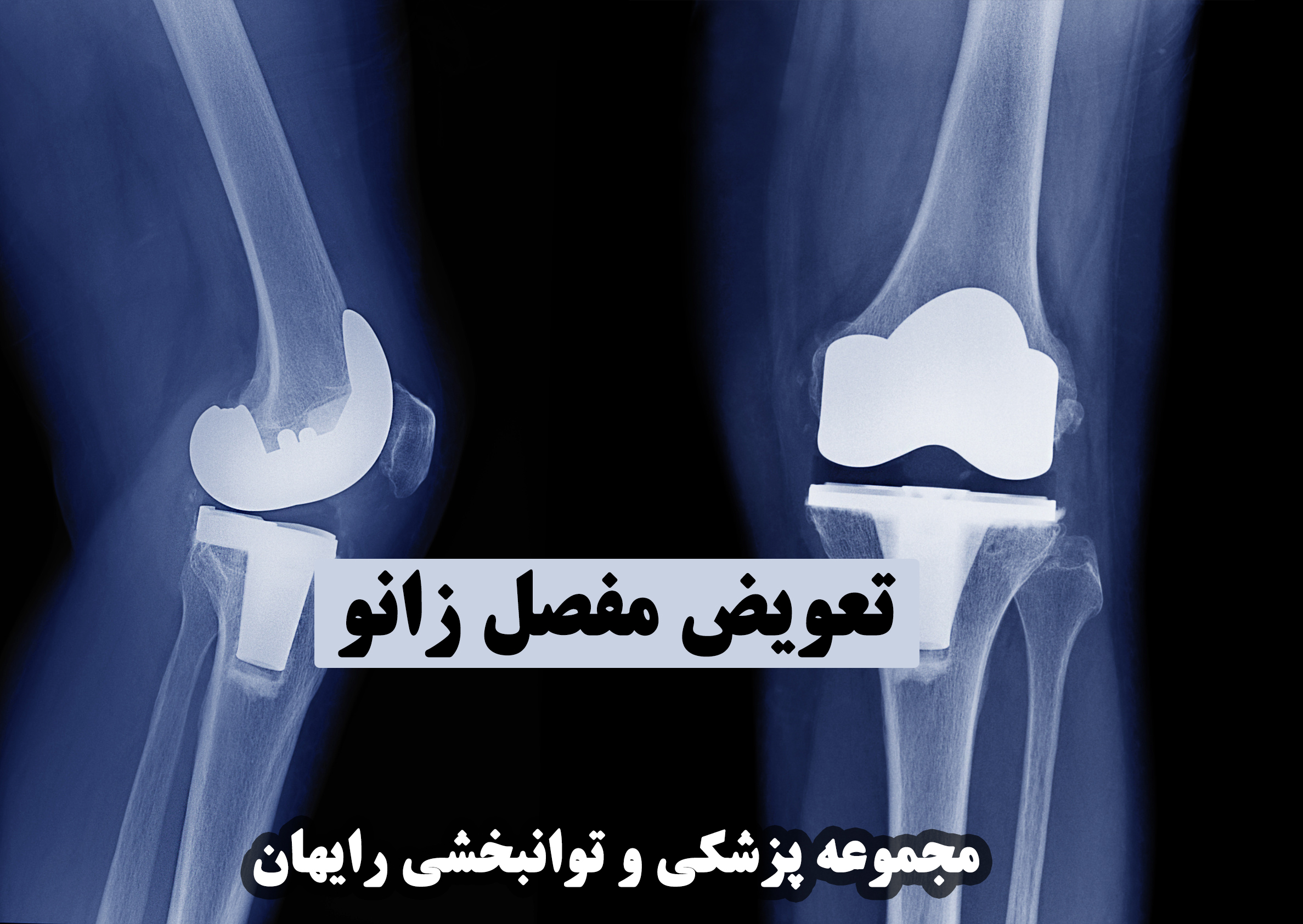 تعویض مفصل زانو